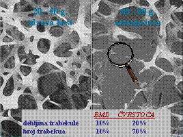 osteoporoaz 1